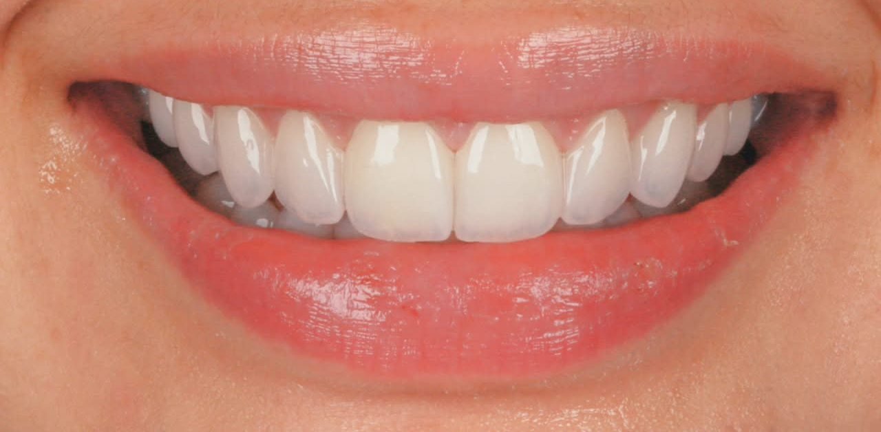 Sorriso natural reconstruído com lentes de porcelana na Villodonto