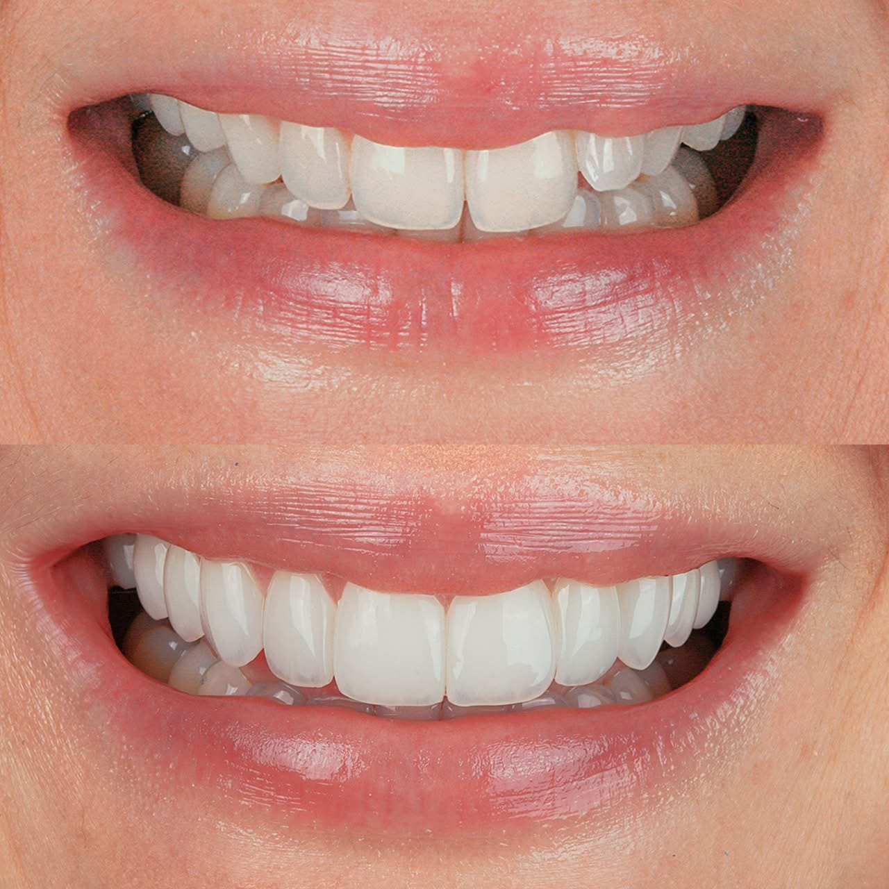 Sorriso reconstruído com lentes de porcelana