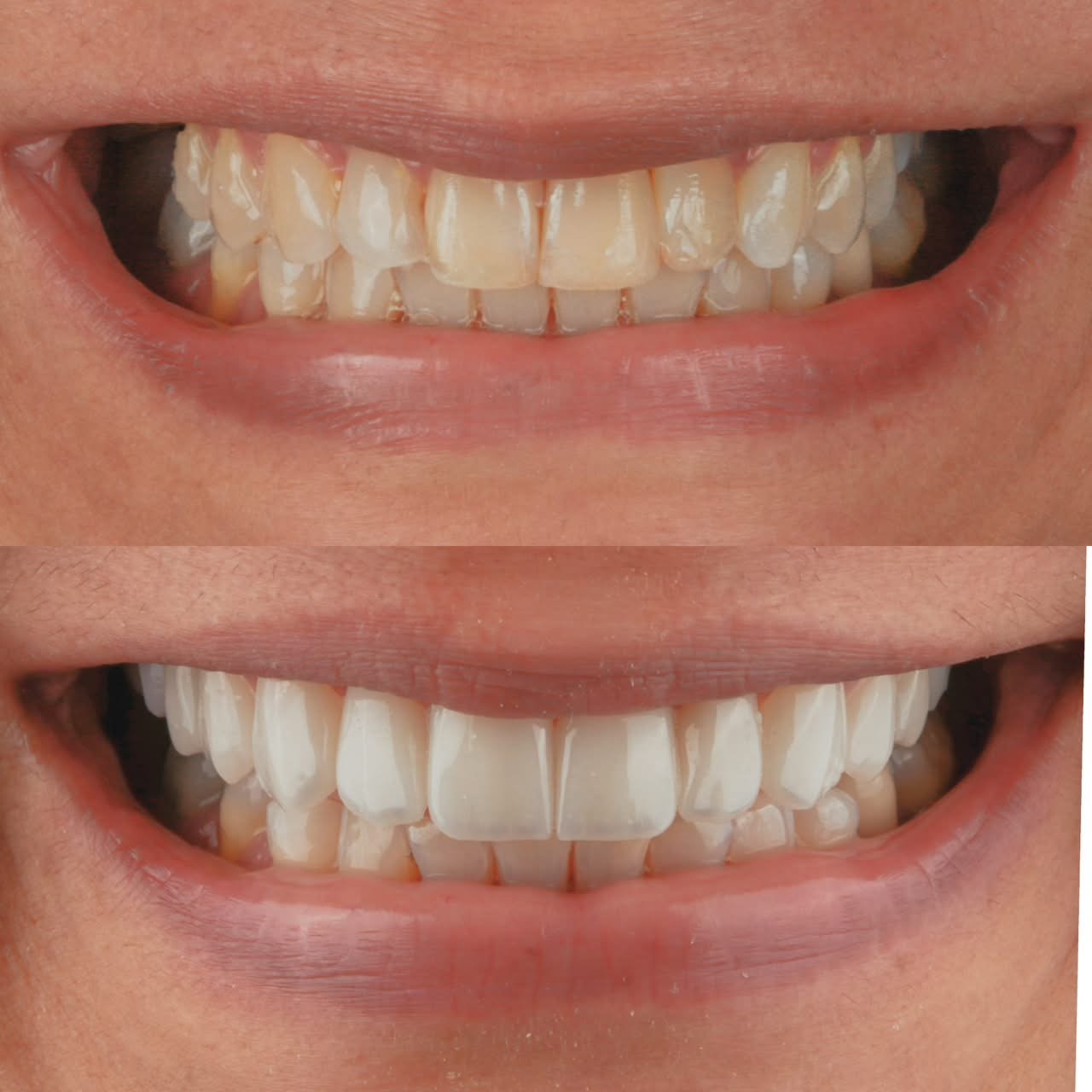 Transformação de sorriso com clareamento e lentes