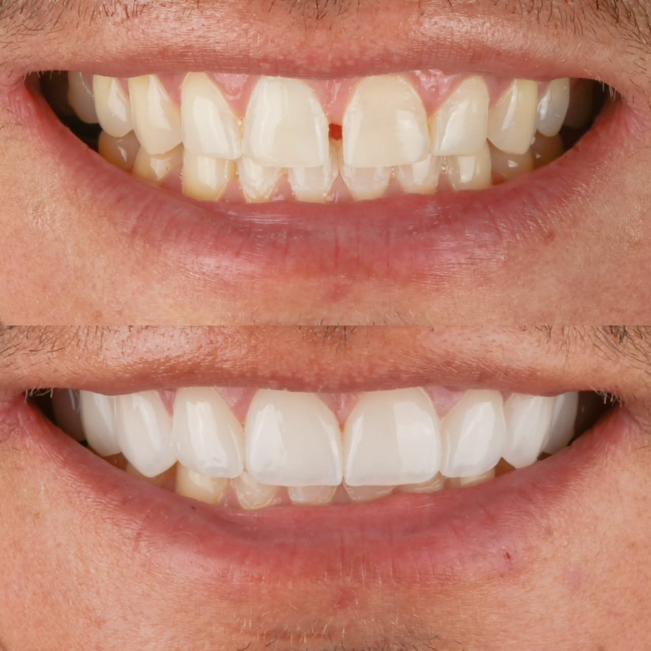 Fechamento de diastema e harmonização do sorriso